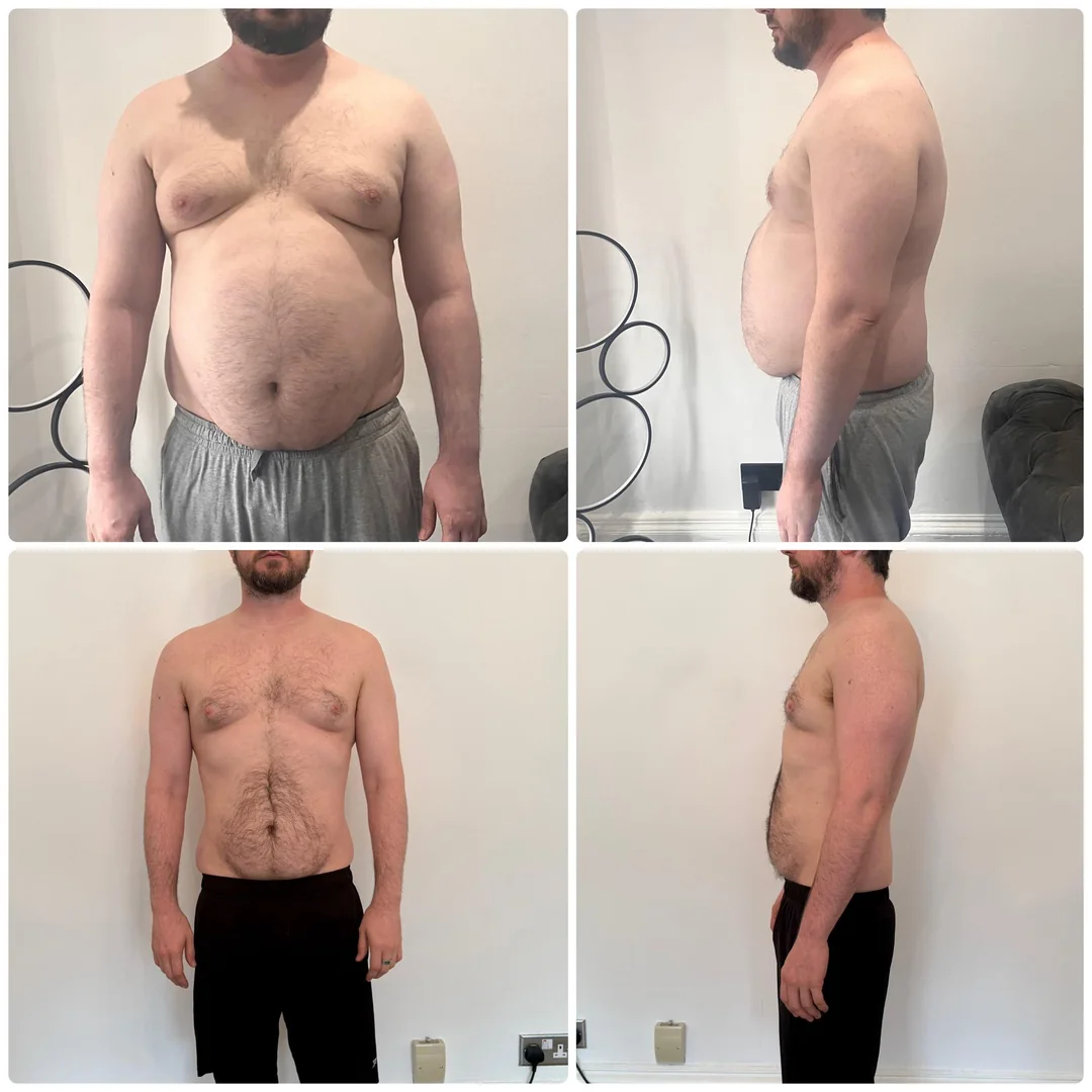 Before and after on retatrutide — James, 38 · Bristol, −24 kg in 7 months